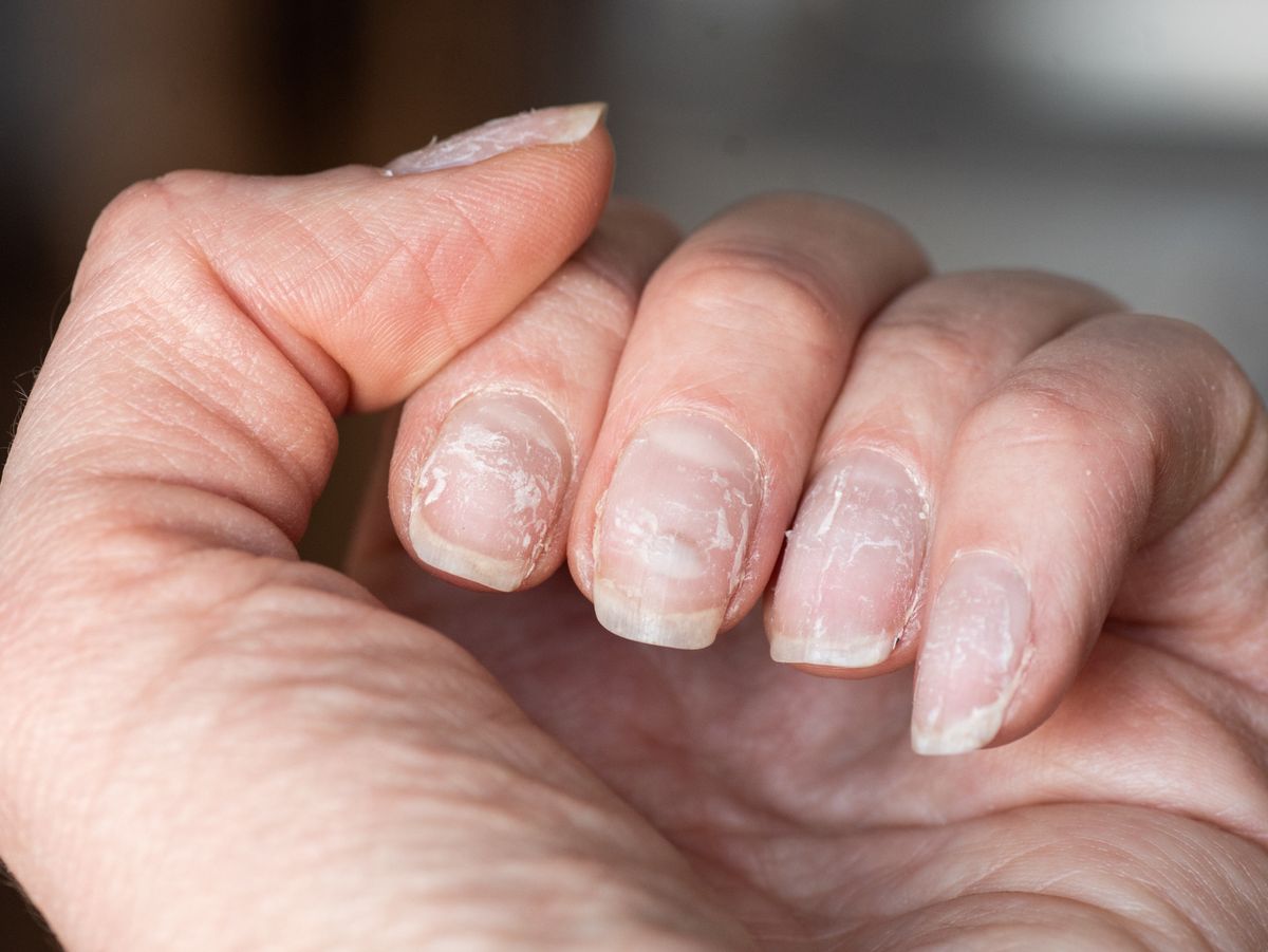 How to Correct Stuck Skin Around The Nails [3 Week Progress] - YouTube